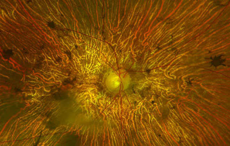 Оптогенетична терапія частково відновлює зір у пацієнта з пігментним ретинітом