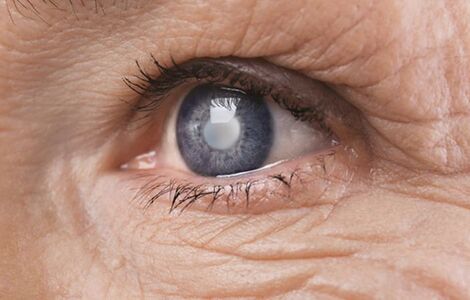 Чи пропонуєте ви трабекулектомію як первинне втручання при пізній стадії глаукоми? <br>Джерело зображення: AdobeStock