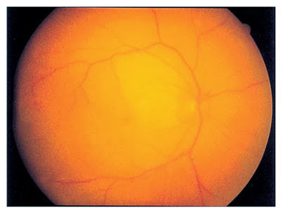 Потеря зрения после операций на позвоночнике